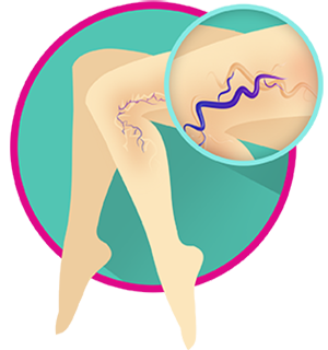 Лечебная программа Варикозу заслон